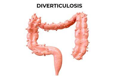 WHAT IS DIVERTICULOSIS?